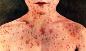 5 Virus famosi e temuti-Morbillo-300x180