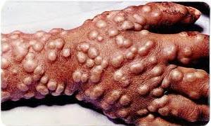 5 Virus famosi e temuti-Vaiolo-300x180