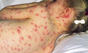 5 Virus famosi e temuti-Varicella-300x180