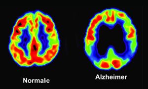 Gli screening per l’Alzheimer-300x180